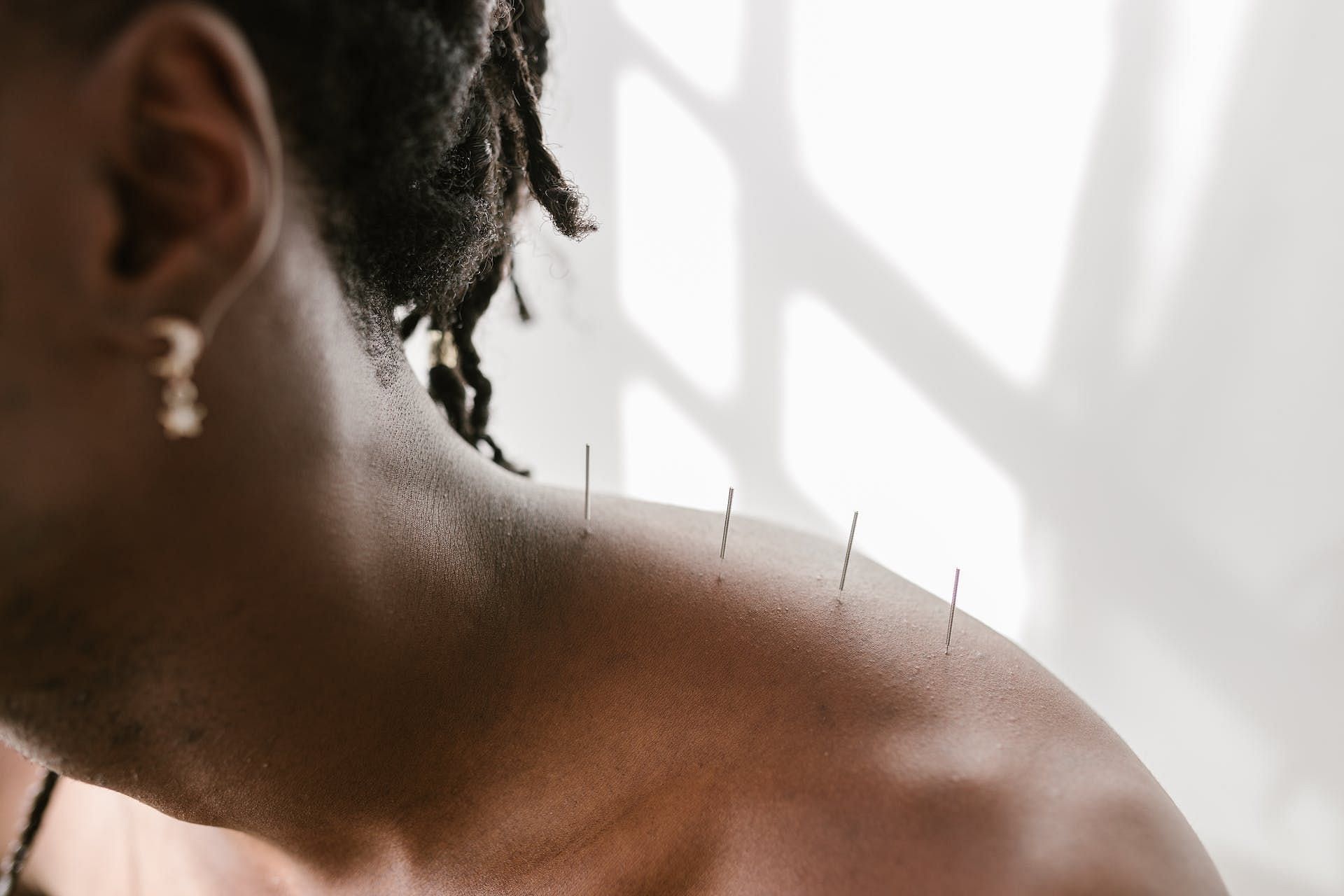 Acupuncture helps treat stiffness. (Image via Pexels/RDNE Stock project)